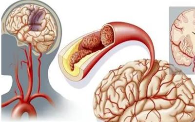 Strengthen the blood vessels of the brain